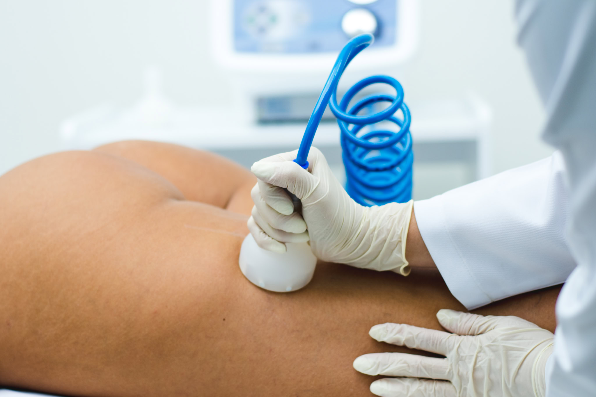 How Vacuum Therapy Helps Reduce Cellulite and Sculpt the Body
